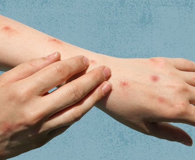 New mpox vaccination site opens in Exeter