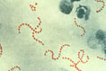 South West has low number of scarlet fever infections