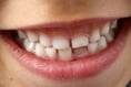 Free dental club amid NHS crisis