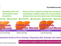 Eighty percent with advanced liver disease in SW are undiagnosed