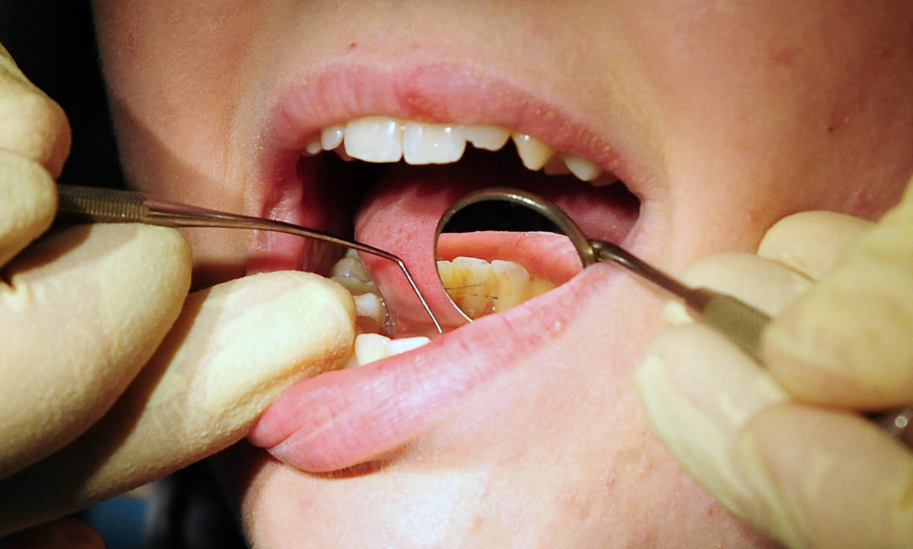 More than two in five people in Devon struggle to get an NHS dentist appointment