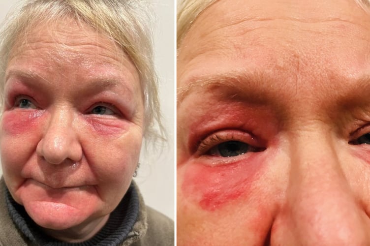 Tina Good's skin infection spread into her bloodstream, causing serious complications