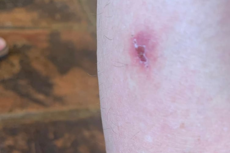 Not for the squeamish... the bites sustained by residents in Calstock have needed treatment including antibiotic cream with residents sustaining bites despite being covered up. (Picture: Alice Clarke)