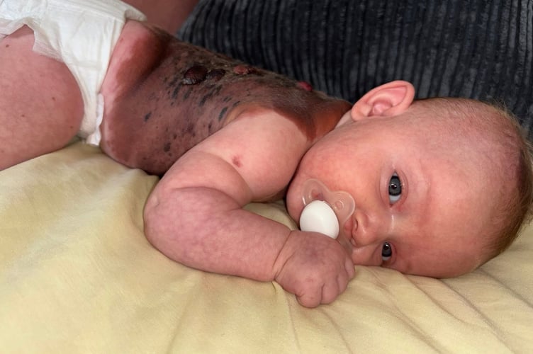 Macey-Mai was born with a Giant Congenital Melanocytic Nevus covering her back. Picture: Katelyn Clarke