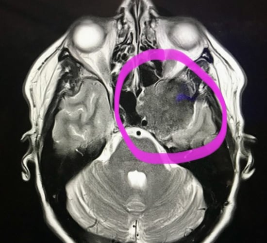 Magda Robertson brain tumour